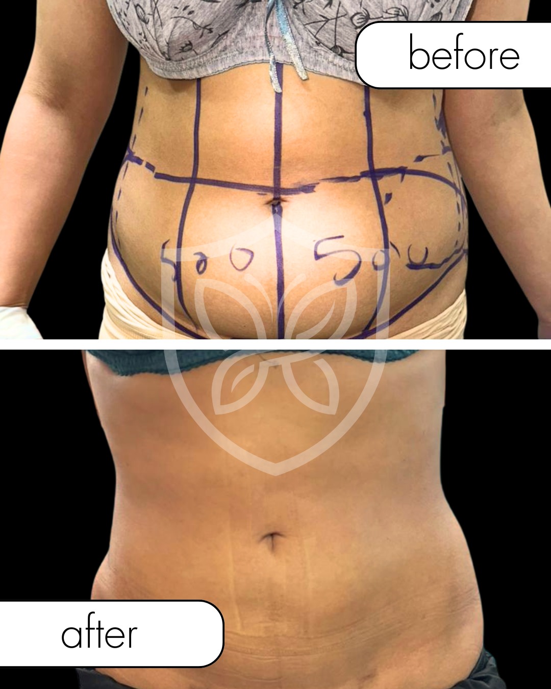 Body Contouring